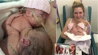 Imagini dureroase! Dupa poza asta unul dintre gemeni a murit! A fost singura data cand mama i-a tinut impreuna in brate iar ei s-au imbratisat!