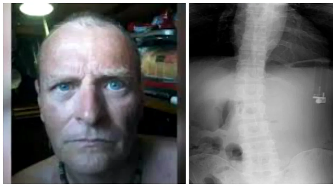 Un barbat de 49 de ani a ajuns la urgente dupa ce a vomitat incontinuu si a acuzat dureri puternice de stomac! Medicii s-au ingrozit cand au vazut ce se afla in stomacul lui