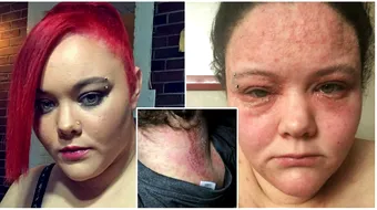 Aceasta mamica a trecut prin clipe HORROR dupa ce a folosit un produs cosmetic pe care orice femeie il are la indemana! Fata ei s-a umflat si e plina de sute de bube