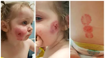 Fetita, muscata la locul de joaca! Micuta a fost agresata de ceilalti copii. Ranile ii vor ramane pe viata