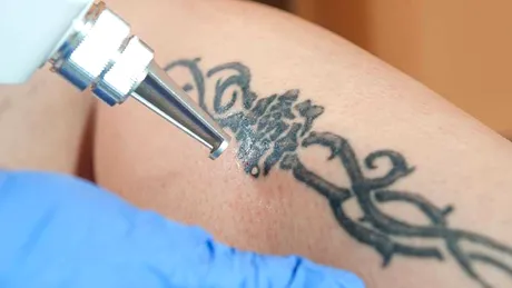 Cum scap de un tatuaj? Dr. Levy îți arată LIVE