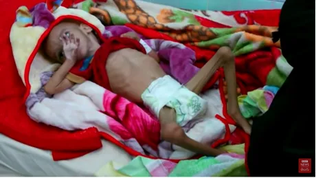 Imagini crunte din Yemen! Tara unde milioane de copii traiesc doar cu apa si au ajuns sa moara de foame! Cazurile lor te vor marca profund! VIDEO