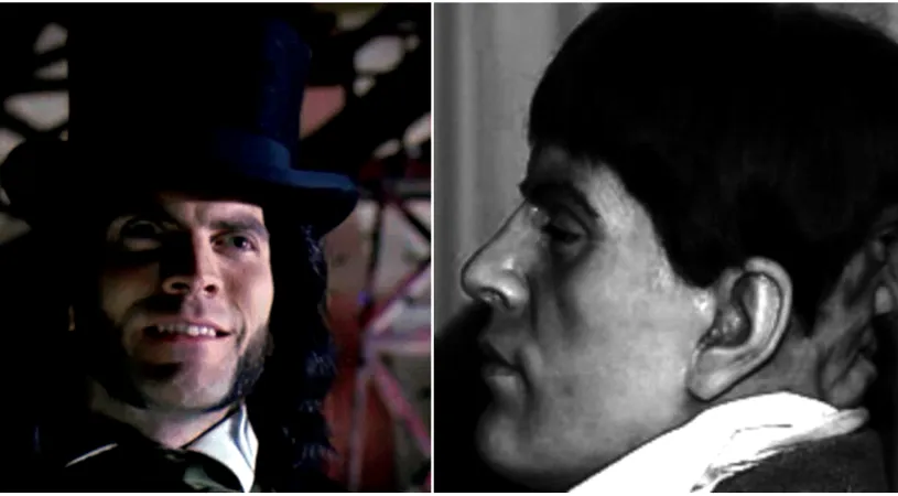 Povestea barbatului cu doua chipuri. I-a socat pe medicii vremurilor si oamenii il vedeau ca pe un monstru daca il intalneau pe strada!