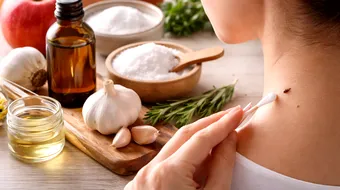 Remediu natural pentru alunițe? Ce este mit și ce spun specialiștii despre îngrijirea pielii