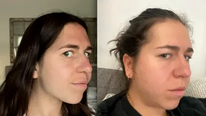 O tânără de 28 de ani s-a deformat din cauza durerilor. Medicii îi spuneau că e de la stres, dar analizele au spus adevărul