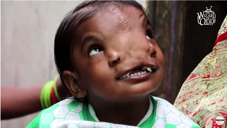 Fetita asta de 8 ani arata groaznic dupa ce s-a nascut cu o malformatie care ii lateste fata intr-un mod inexplicabil! VIDEO