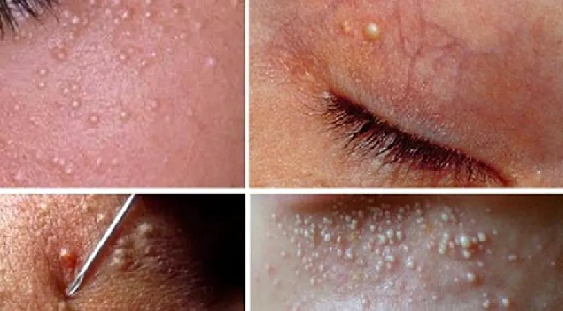 Cum scapi de punctele albe de pe fata! Ce trebuie sa faci pentru ca tenul tau sa se curete in cateva zile