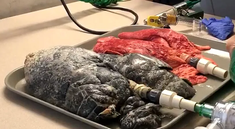 Imaginile socante care te vor face sa te lasi de fumat! Comparatia ireala intre plamanii unui fumator si ai unui om sanatos! Ce se intampla cand se pompeaza aer in ei VIDEO