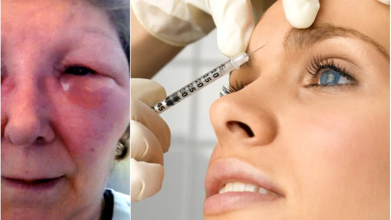 Au mers sa isi faca injectii cu botox, dar rezultatul a fost unul infricosator 