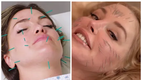 Ai vazut vreodata de aproape cum arata acupunctura faciala?! Pare extrem de dureros. Atentie, imagini care te pot afecta emotional VIDEO