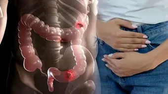 Semnul de alarmă al cancerului de colon pe care nu trebuie să îl ignori. Când e cazul să mergi urgent la medic