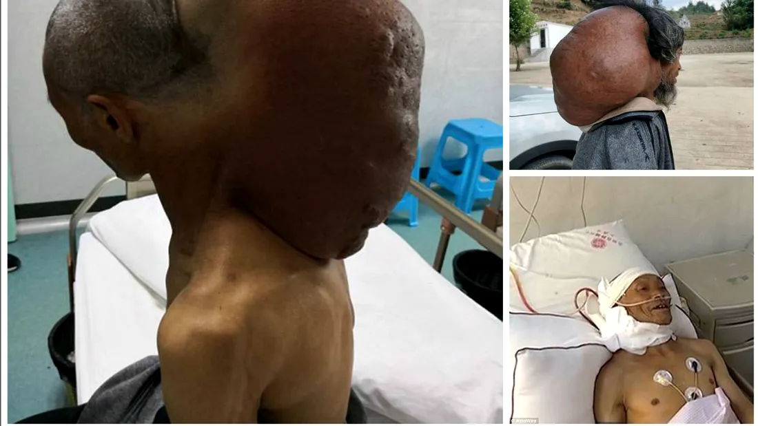 Avea o tumora de 15 kilograme pe ceafa pe care a ignorat-o timp de 50 de ani! Medicii s-au chinuit 10 ore sa-l opereze! Cum arata barbatul?!
