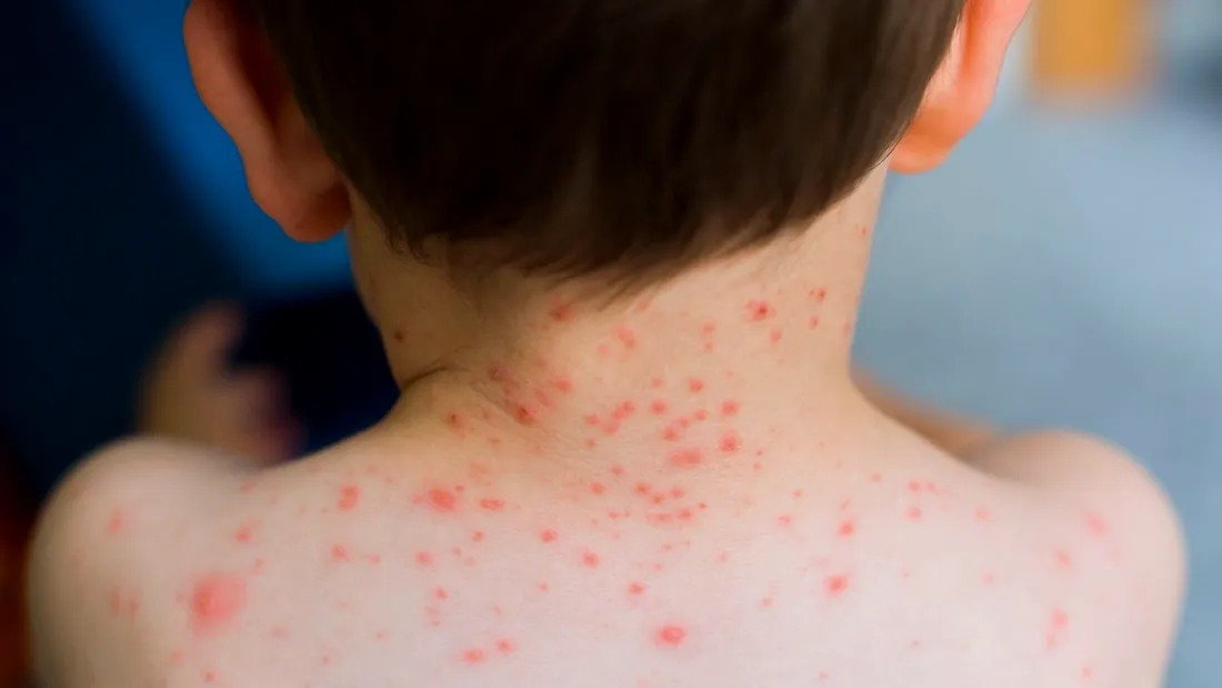 Ce este varicela. Cauze, simptome și tratament