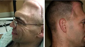 A fost diagnosticat cu cancer la creier si medicii i-au dat maxim 6 ani de trait! Cum a reusit sa traiasca peste 20 de ani si sa castige lupta cu cancerul de 4 ori!