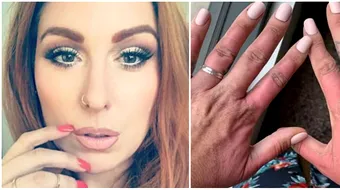 Si-a ars mainile dupa ce a taiat un fruct, in soare! Femeia abia si-a revenit din soc!