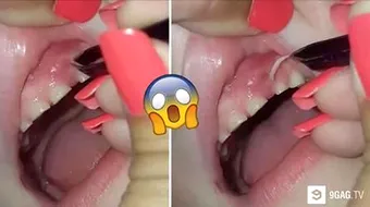 Oribil! Ce a scos o mamica din gingia fiului ei. Le-a extras cu penseta: erau 27 la numar!!! VIDEO