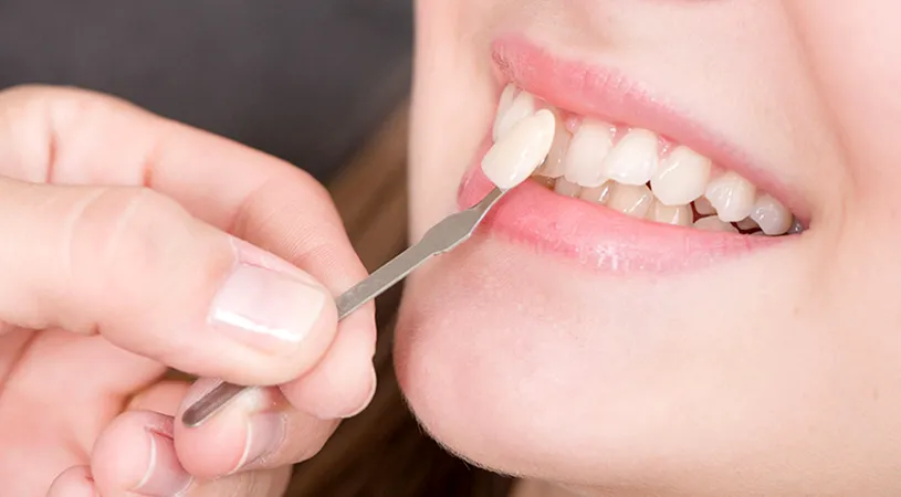 De ce recomandă medicii stomatologi fațetele dentare