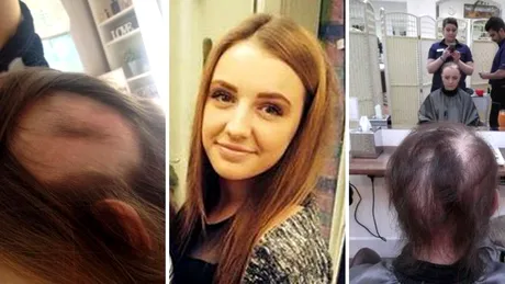 Drama adolescentei care la 19 ani si-a pierdut tot parul! Boala autoimuna de care sufera a transformat-o radical. Mare atentie la simptome