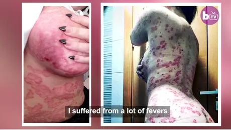 Are cea mai grava boala de piele, dar este fotomodel. Cum poate sa arate cand isi da jos hainele si ce pateste, an de an VIDEO