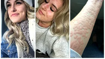 Femeia alergica la iarna! Ce se intampla cu pielea ei daca nu se imbraca bine. Imaginile sunt SOCANTE!