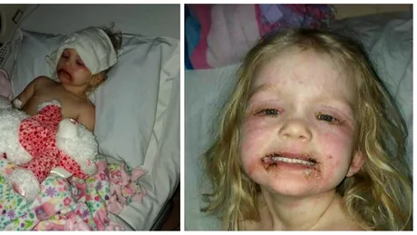Fata de 3 ani, de urgenta la spital din cauza mamei sale! Ce a facut micuta de i s-a umflat toata fata. Parintele ei e plin de regrete!