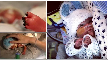 S-a nascut la 23 de saptamani si i s-au innegrit degetelele de la picioare! Boala pe care se chinuie sa o invinga acest bebelus