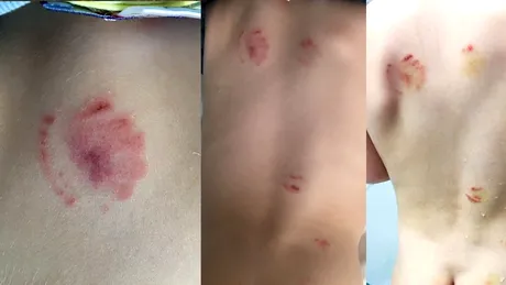 Si-a luat copilul de la gradinita si a observat pe corpul lui mici rani rosii. Cand i-a dat hainele jos, s-a socat! Ce avea micutul e de nedescris