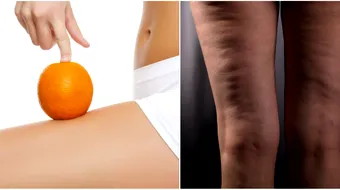 Cum combati celulita corect. De ce cremele anticelulitice uneori nu functioneaza