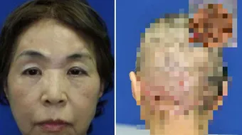 Femeia asta a ramas fara SCALP in urma unui accident. Ce masinarie i-a smuls pielea de pe cap si urechile. Cum arata