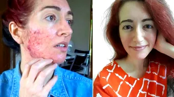 A scapat de acnee, dupa 15 ani de incercari esuate! Metoda femeii este una neobisnuita. Ce face zilnic VIDEO