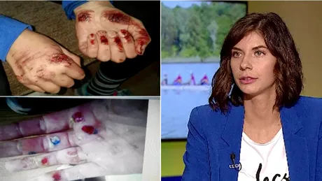 Gianina Beleaga, medaliata cu aur la canotaj, are mainile distruse. Cum arata ranile FOTO