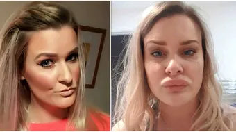 Alergia misterioasa de care sufera aceasta femeie. Arata de parca si-a injectat buzele cu botox VIDEO