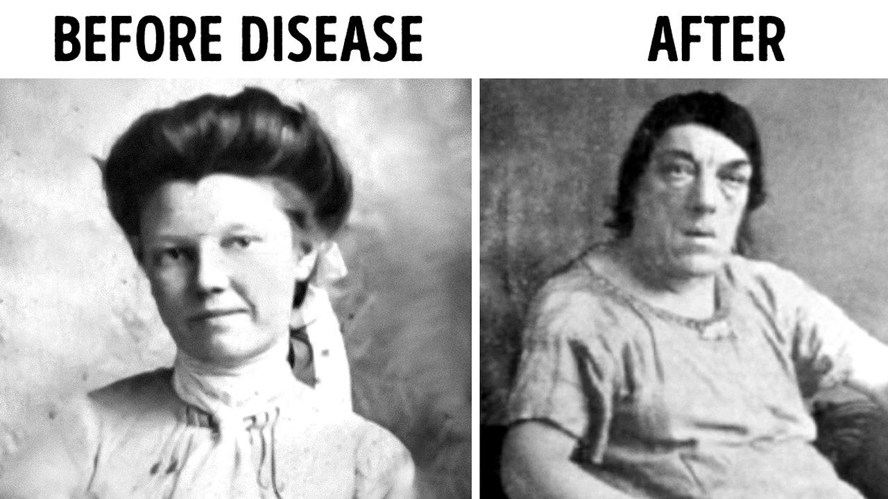 Cum arată cea mai urâtă femeie din lume! Povestea tristă a lui Mary Ann,  asistenta căreia i s-a schimonosit fața peste noapte