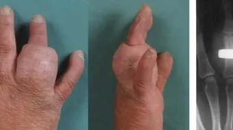 Pielea de pe deget i-a ‘inghitit’ inelul de nunta! Cum a fost posibil asa ceva. Medicii sunt socati de acest caz