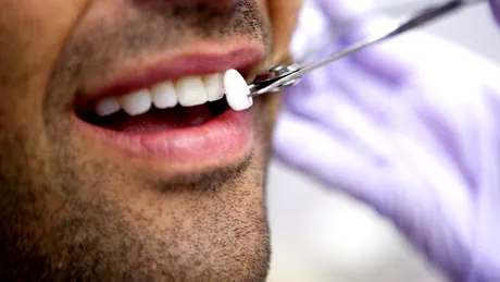 Ingrijirea fatetelor dentare in 5 pasi. Cel mai bun mod de a pastra un zambet alb