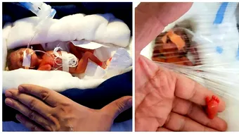 Bebelusul cat o ciocolata! S-a nascut la 28 de saptamani, cu o greutate de 400 grame. Ce spun medicii