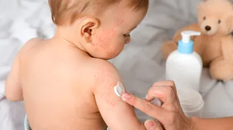 Remediu pentru pielea atopică la copii. Ce poate ajuta la calmarea uscăciunii și a disconfortului
