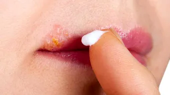 Tratamente pentru herpes care te vindeca in scurt timp. Ce folosesti cand iti apar veziculele pe fata sau zona genitala