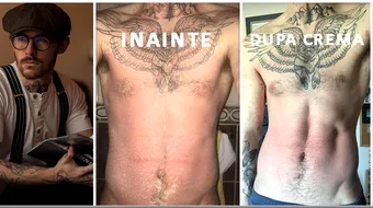 Pielea lui ‘cadea ca fulgii de zapada’! Cum s-a vindecat acest barbat de psoriasis cu o crema ieftina