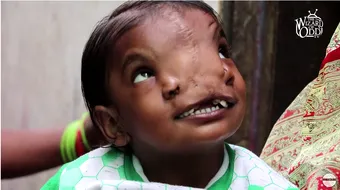 Fetita asta de 8 ani arata groaznic dupa ce s-a nascut cu o malformatie care ii lateste fata intr-un mod inexplicabil! VIDEO