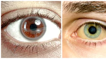 12 lucruri pe care ochii le spun despre sanatatea ta! Nu le ignora, unele sunt grave