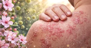Psoriazis primăvara: de ce se agravează simptomele și ce legătură au alergiile, soarele și schimbările de temperatură