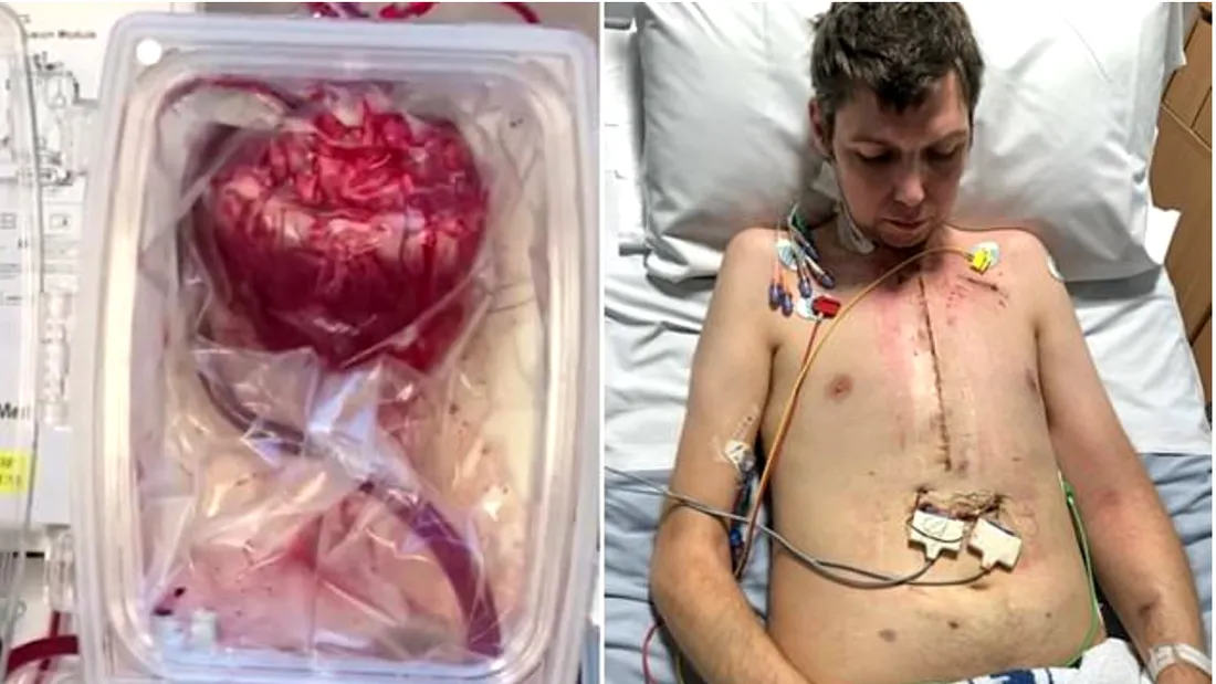 Fantastic! Barbatul de 34 de ani care a fost salvat de la moarte cu un transplant! A primit o inima intr-o cutie in care a stat timp de 5 ore!