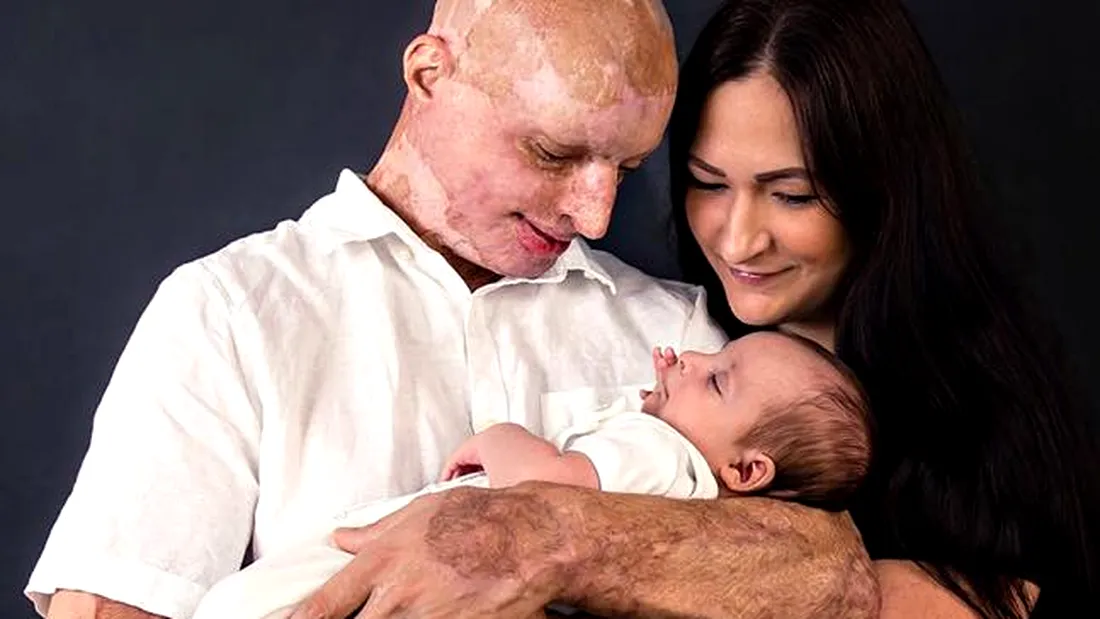 Ce familie frumoasă are acum Daniel Rotariu, tânărul desfigurat cu acid sulfuric de fosta iubită