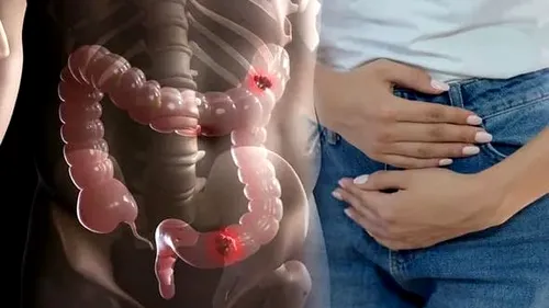 Atenție, nu ignorați! Care sunt primele simptome ale cancerului de colon și cum poate fi depistat
