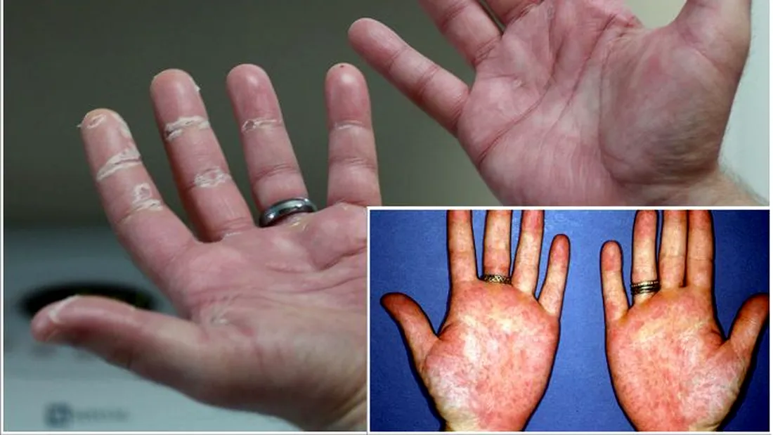 Semnele din palme care iti arata ca ai cancer. Daca sunt prezente, trebuie sa mergi urgent la medic