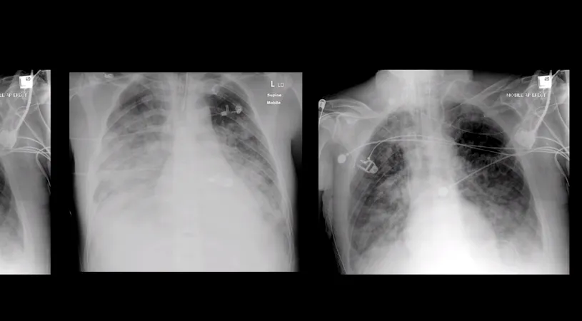 Cum sunt plămânii afectați din cauza coronavirusului! Videoclipul care arată cum se pot deteriora organele din corp