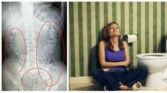 S-a constipat si a ajuns la spital. Cand i-au facut ecografie, au fost socati de ce au gasit in intestinele fetei de 14 ani