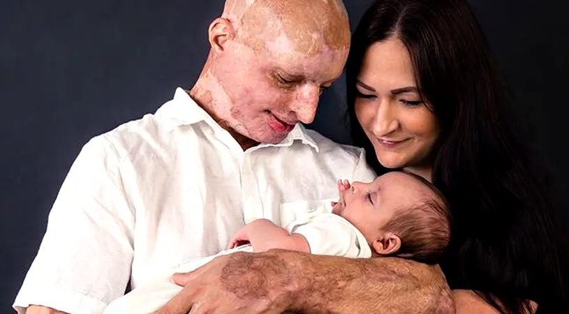 Ce familie frumoasă are acum Daniel Rotariu, tânărul desfigurat cu acid sulfuric de fosta iubită