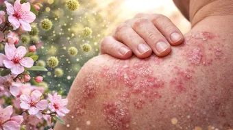 Psoriazis primăvara: de ce se agravează simptomele și ce legătură au alergiile, soarele și schimbările de temperatură